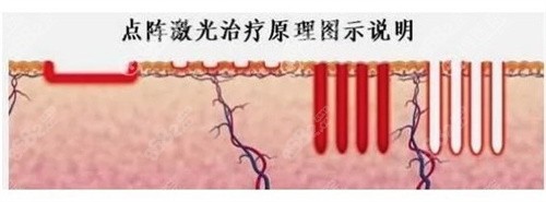 點陣激光祛疤 點陣激光祛疤