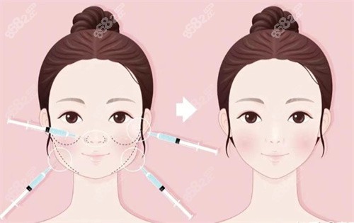 杭州馮嘯醫(yī)生微調(diào)多少錢(qián)？唇4000+全臉2.6w+含不同位置注射價(jià)位及優(yōu)勢(shì)解讀