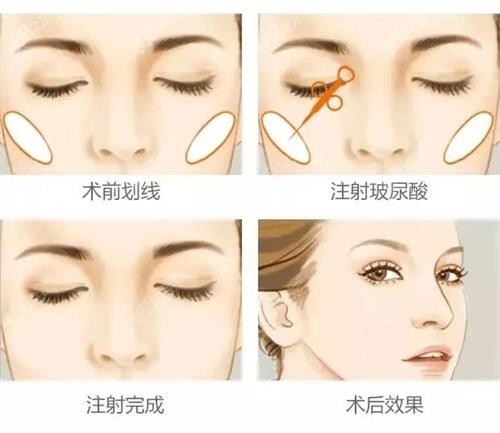玻尿酸前后注射示意圖 玻尿酸前后注射示意圖