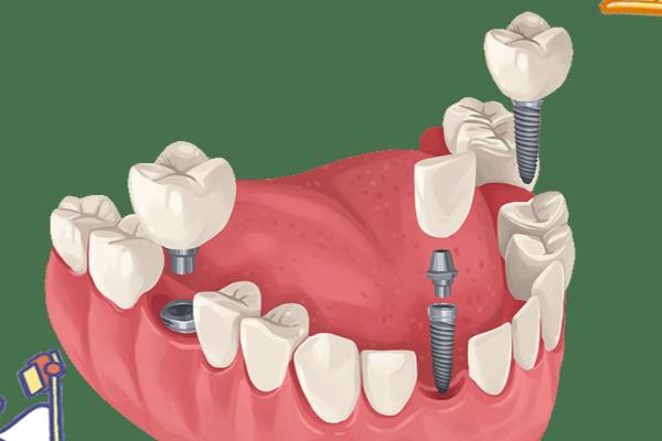 汕尾牙科排名出爐！種植牙 3280 元起，這 5 家口碑醫(yī)院閉眼選