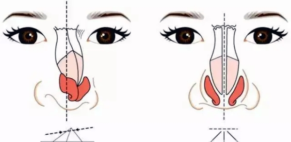 武汉徐乃杰医生鼻修复