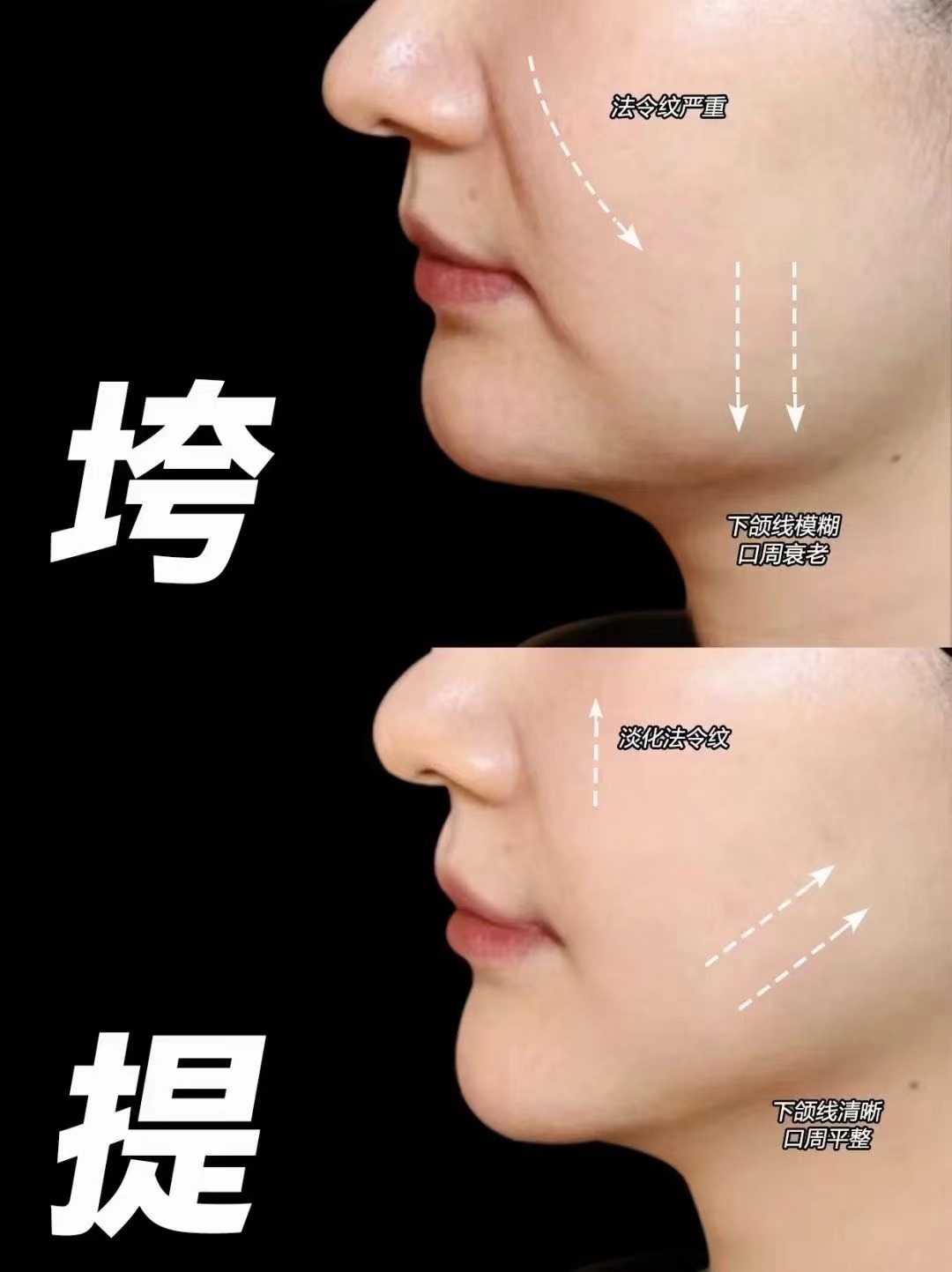 做完超聲王的感覺怎么樣？臉部緊致不腫不痛，價(jià)格2萬起效果維持1年