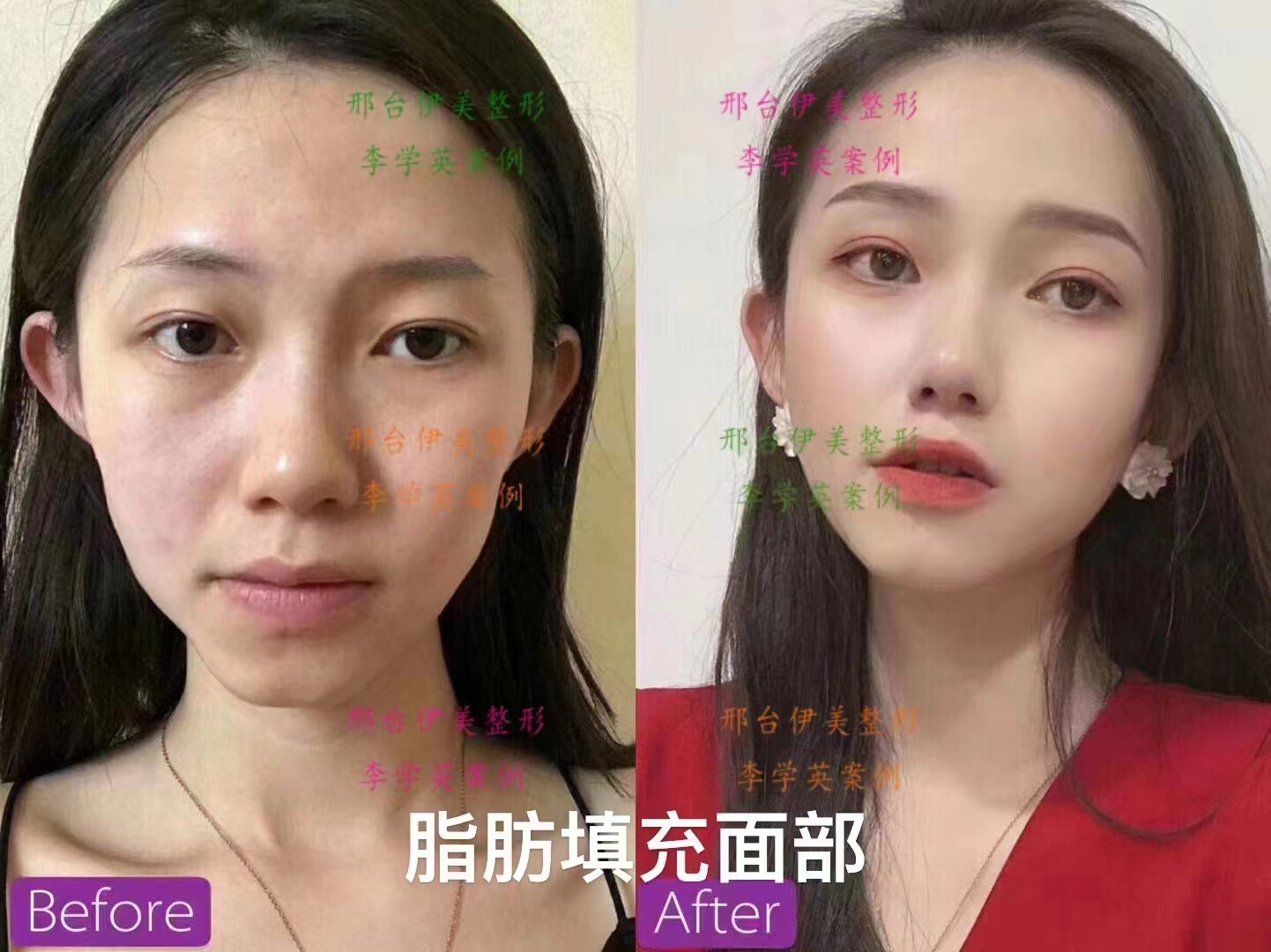 骨水泥顱頂填充術(shù)全過程及前后對比真實盤點，3-6萬打造高顱頂效果驚人！