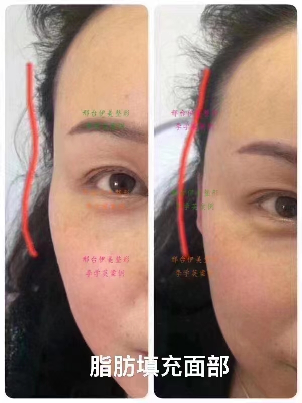 骨水泥顱頂填充術(shù)全過程及前后對比：手術(shù)當天流程揭秘