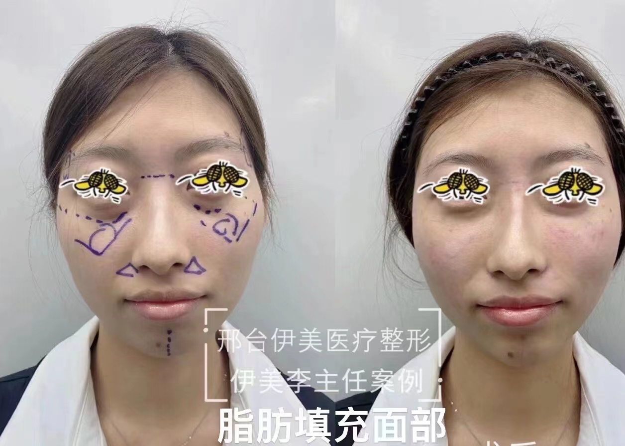 骨水泥顱頂填充術(shù)全過程及前后對比：術(shù)后護理與修復指南m.66ub.cn