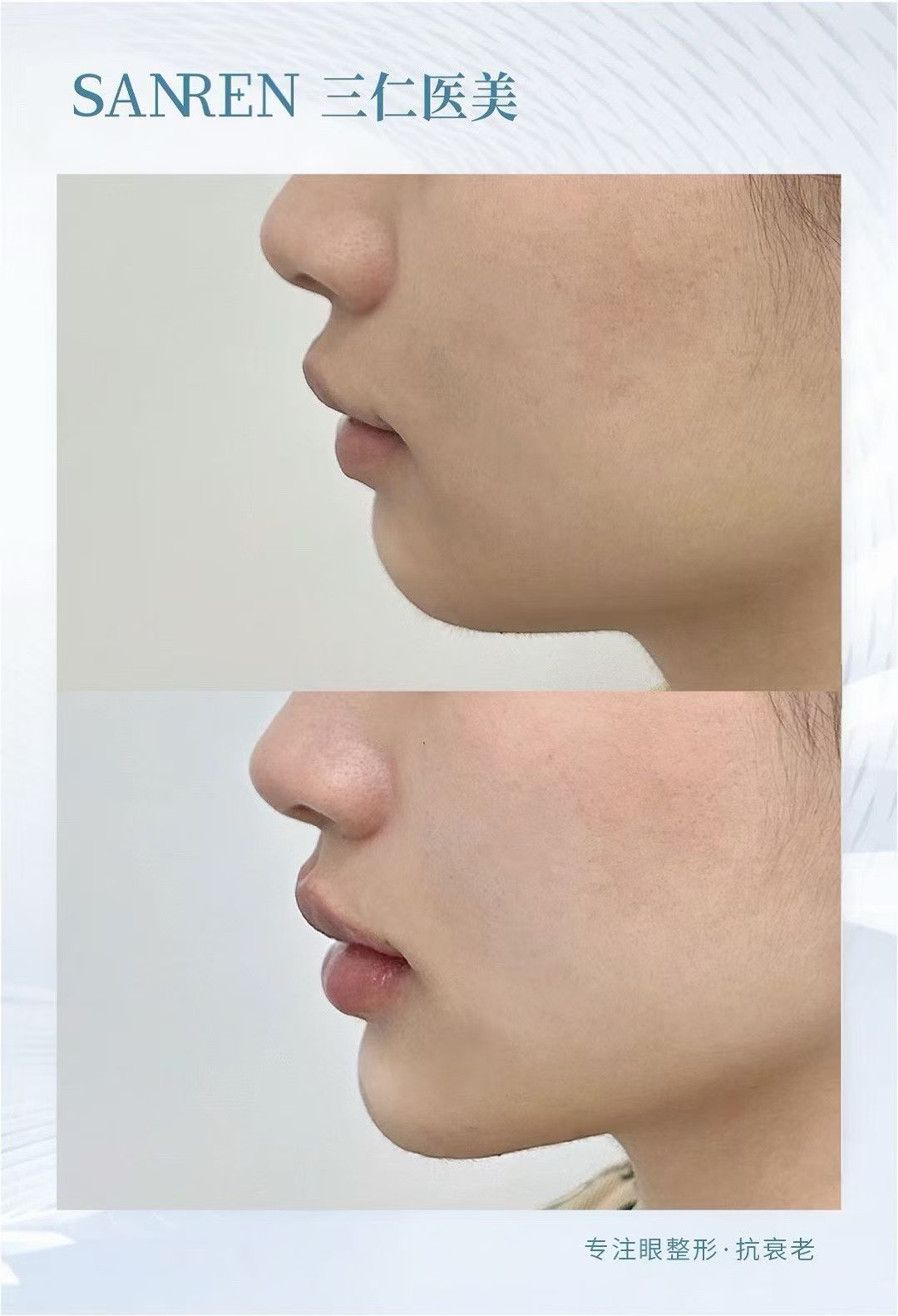 韓國知名玻尿酸品牌大揭秘：十大熱門品牌+選品指南全解析