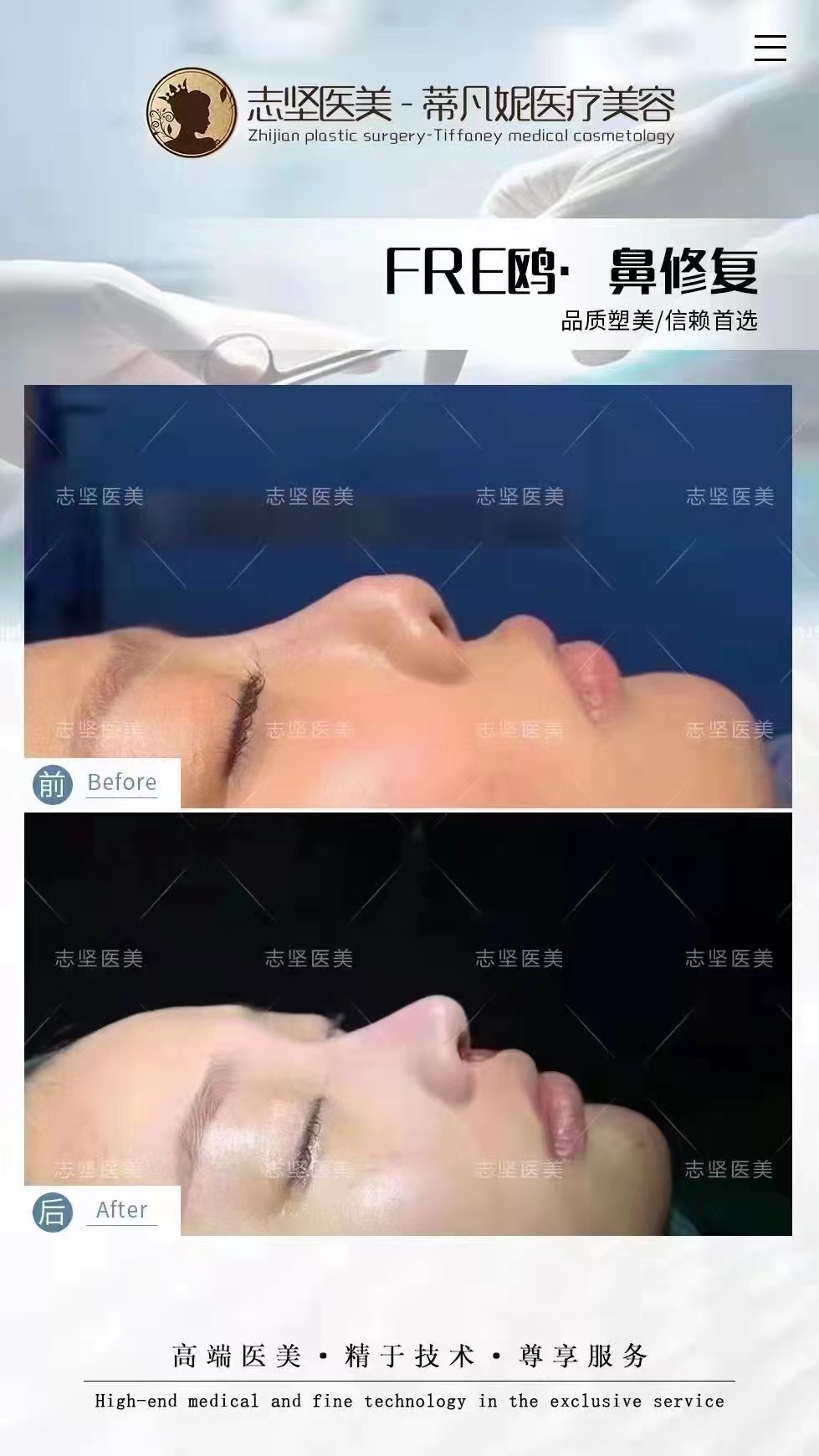 蔡跃波做脸部馒化怎么样？微创减容+射频紧致，患者反馈消肿快、轮廓更精致！ 