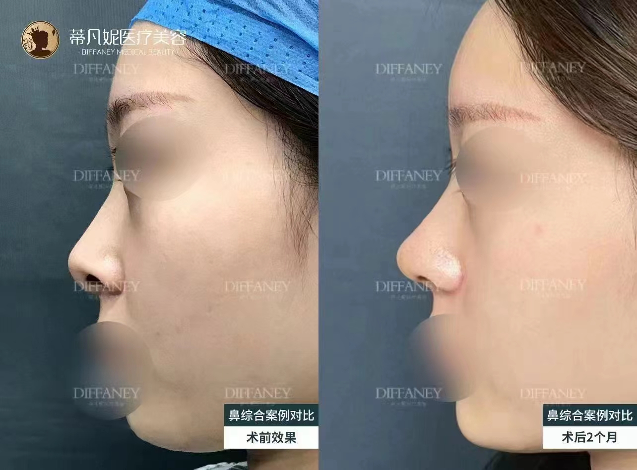 三、蔡躍波做臉部饅化的成效保護：患者真實反饋印證自然度