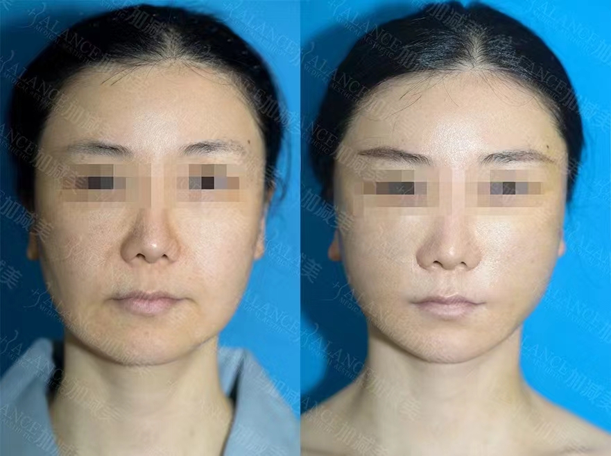 總結(jié)：蔡躍波做臉部饅化，自然修復(fù)與專精保護兼具