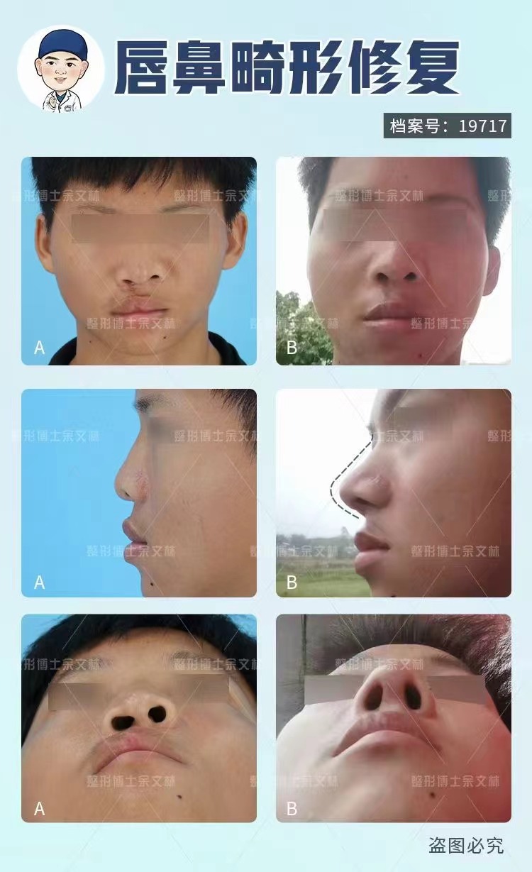 北京沃爾劉彥軍修復(fù)鼻子怎么樣？眾多成功案例見證其精湛技藝與卓越審美！ 