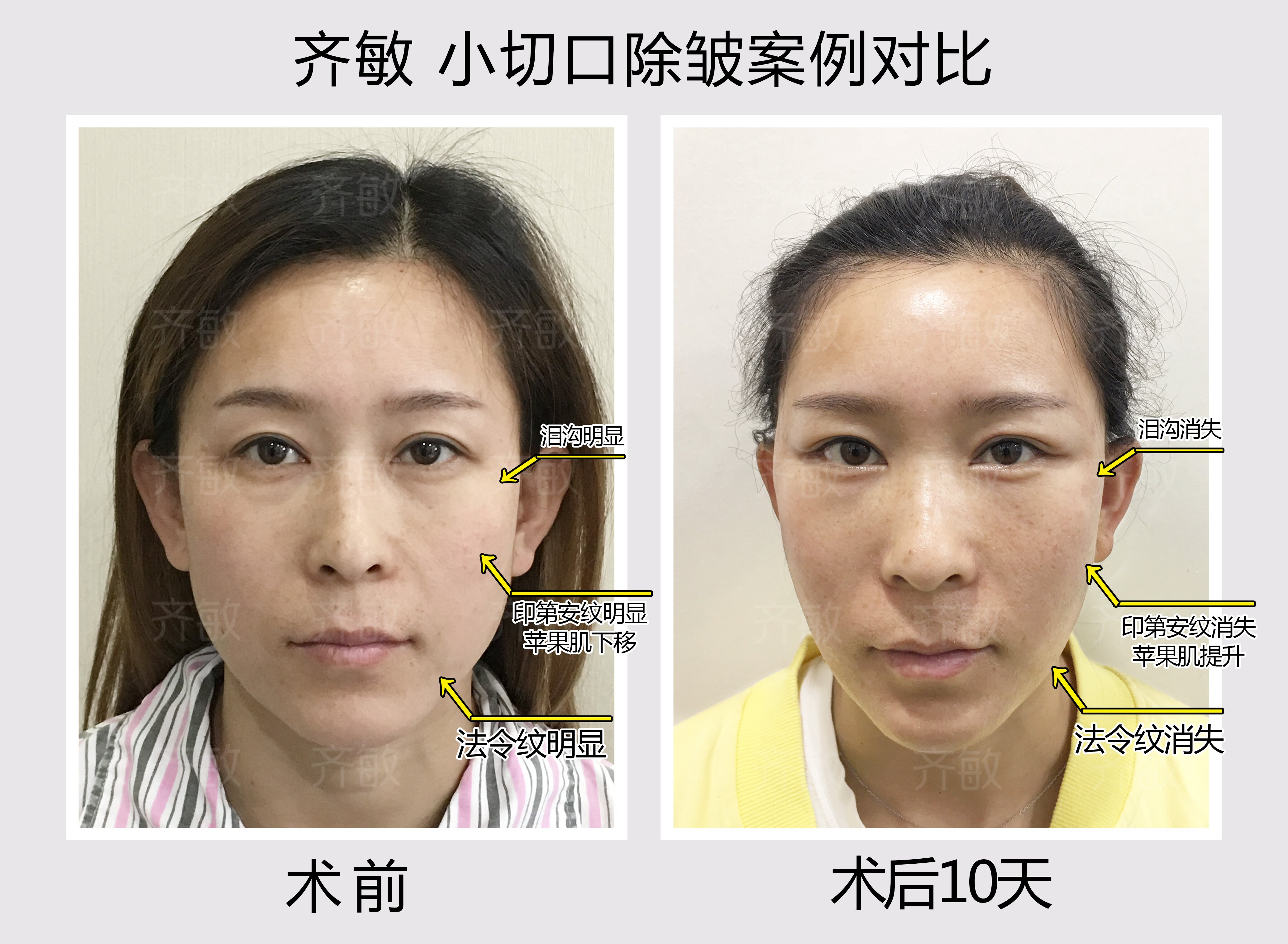 上海九院整形科價目表：切開雙眼皮11000元起，鼻綜合40000元起，2026權(quán)威參考！ 