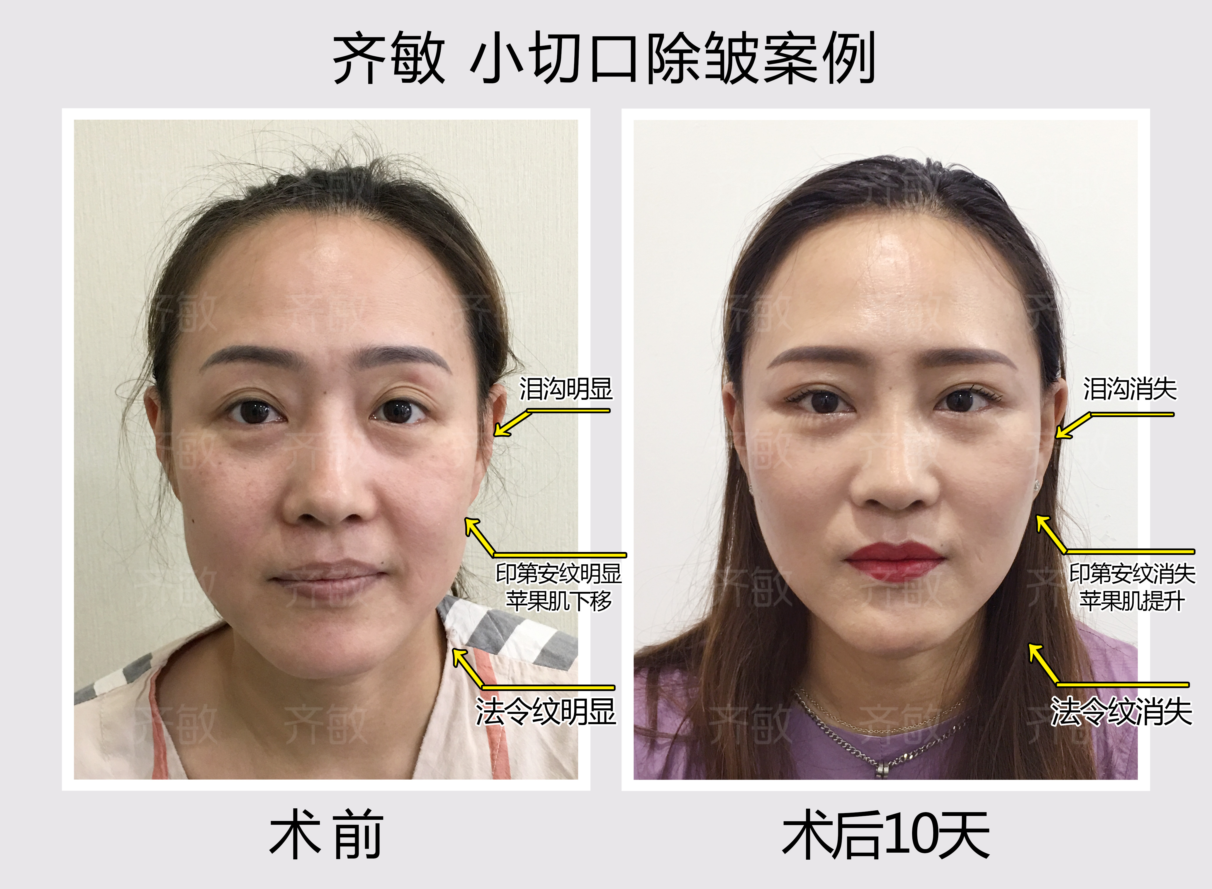 1. 上海九院整形科熱門項(xiàng)目價(jià)目表：雙眼皮、鼻綜合等核心價(jià)格一覽