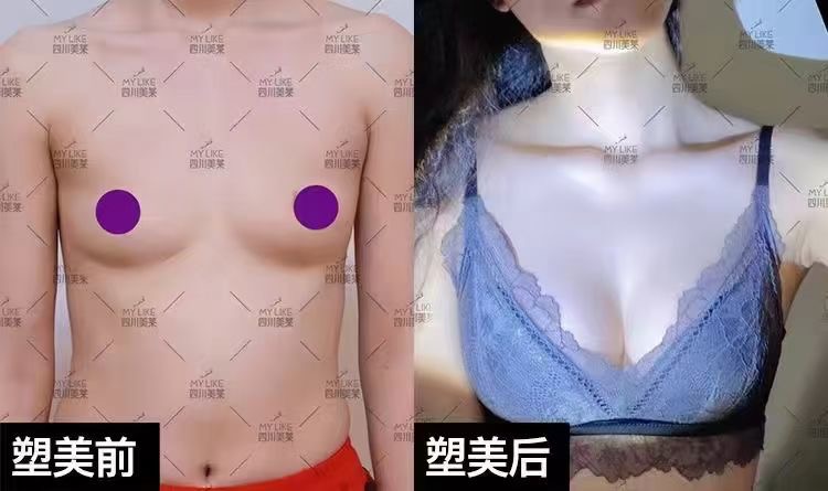 余力醫(yī)生隆胸價格及技術(shù)優(yōu)勢——值不值得選？