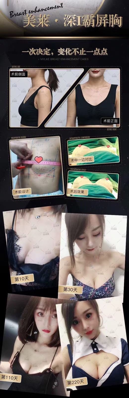 何金光醫(yī)生隆胸費用與實例分享——性價比之選