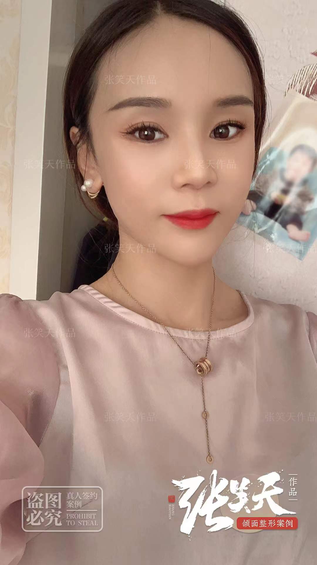 上海九院下頜骨整形預(yù)約攻略