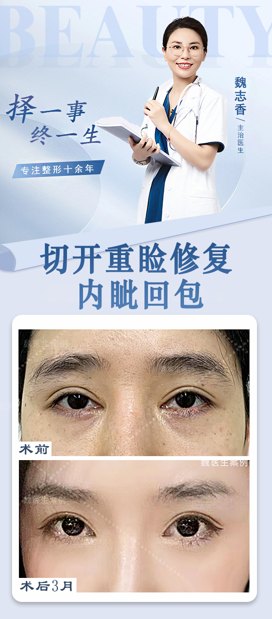 謝峰醫(yī)生：雙眼皮修復(fù)的“問(wèn)題解決能手”