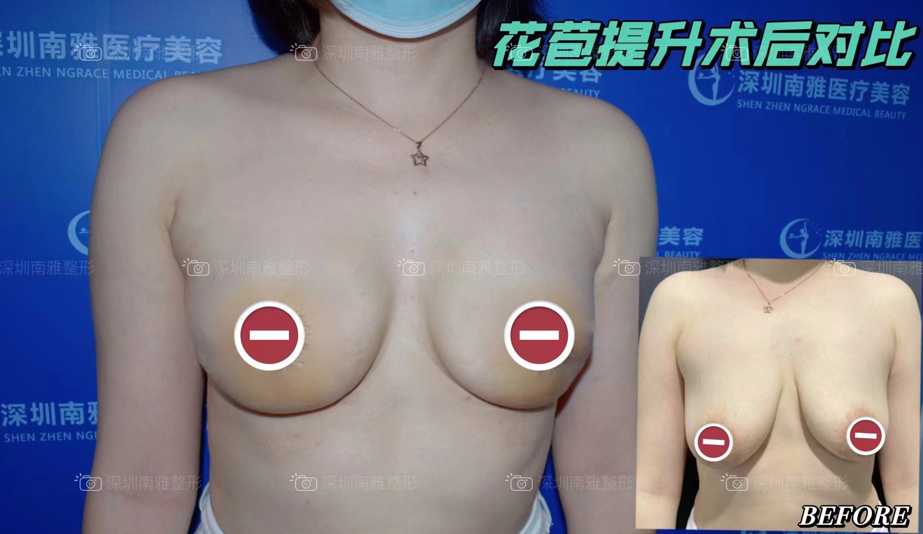 深圳碧莲盛植发技术实力咋样