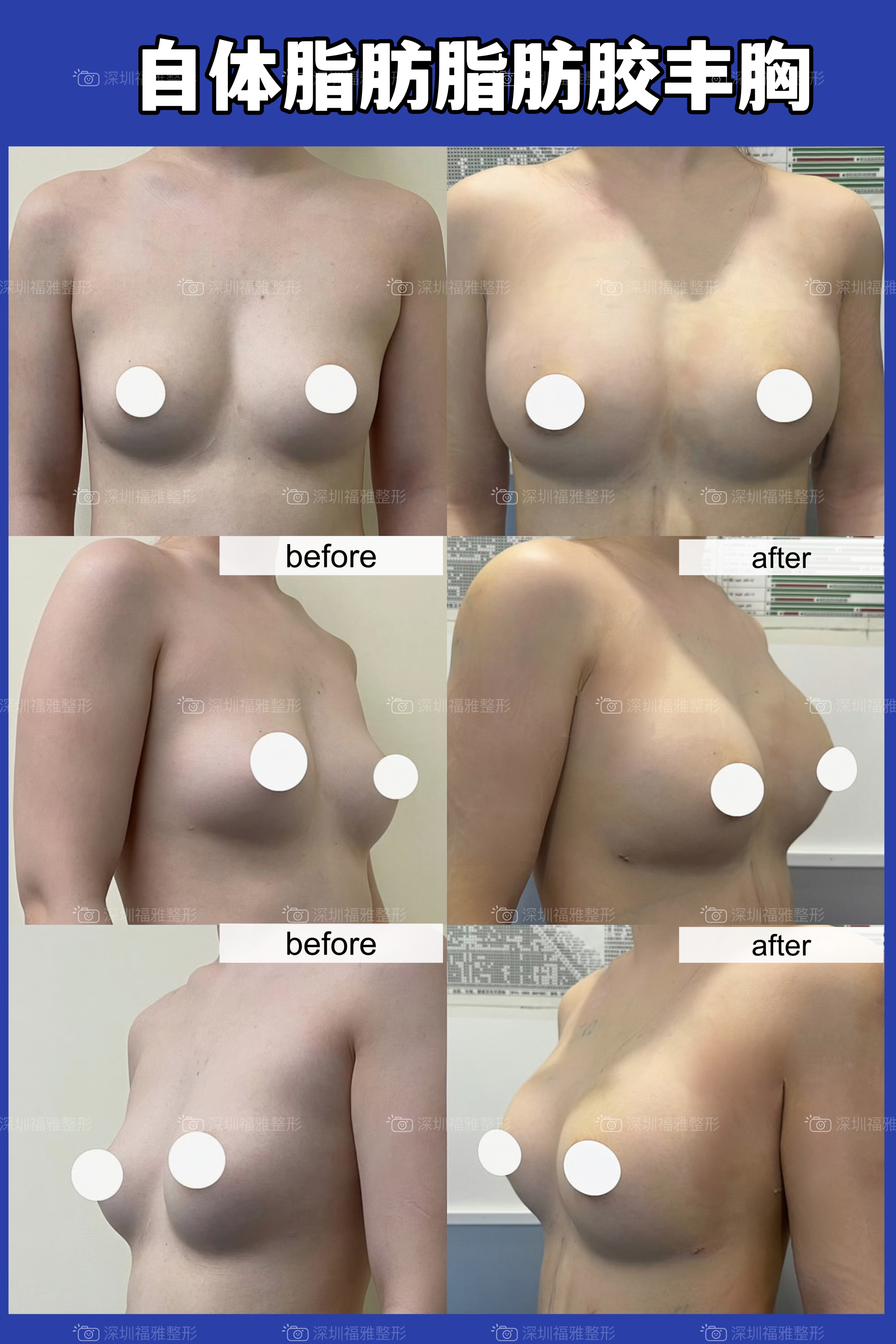 深圳碧莲盛植发预约及乘车指南