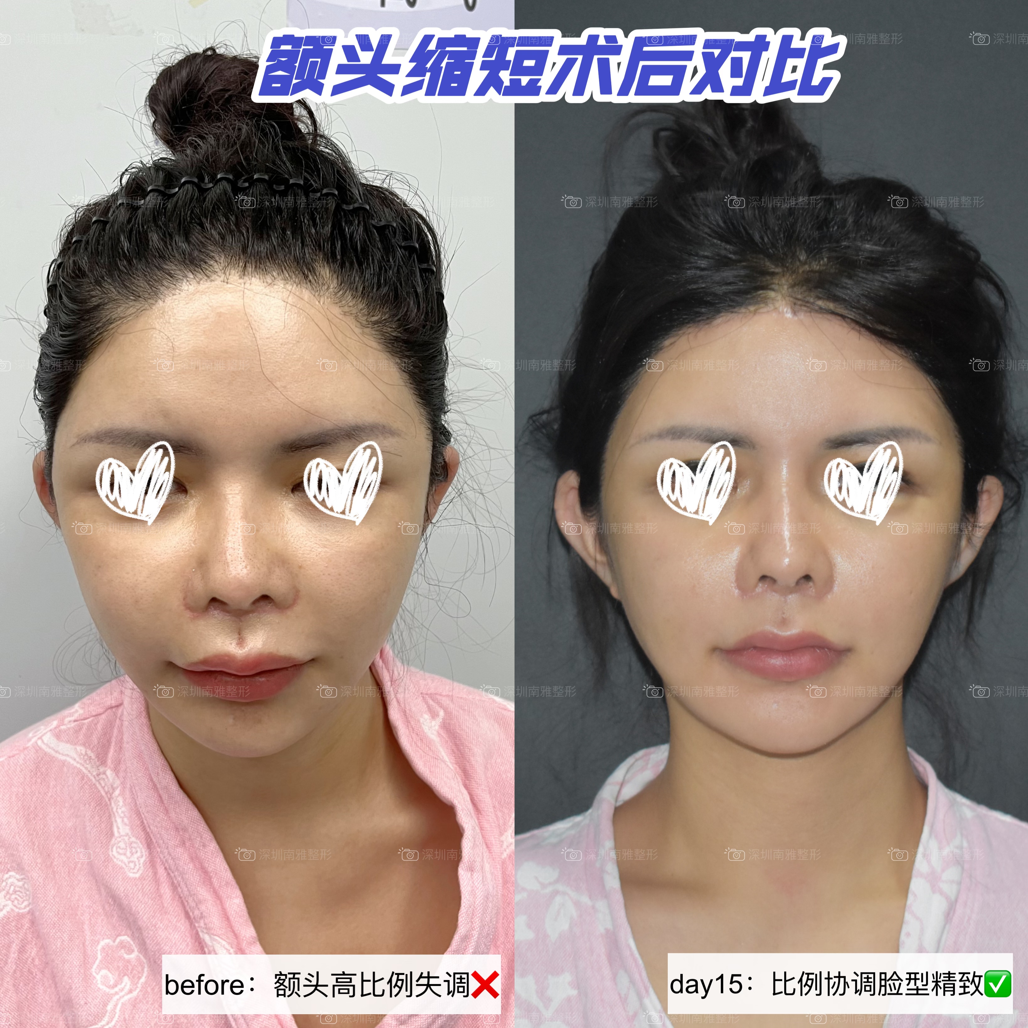 骨水泥顱頂填充術(shù)全過程及前后對比：真實實例成效震撼來襲