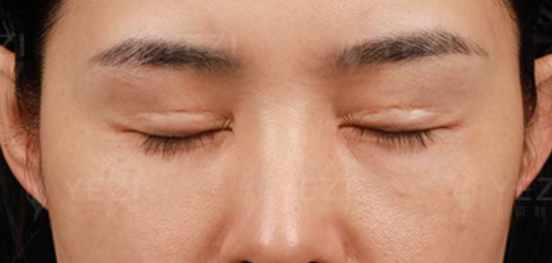 上海九院雙眼皮修復(fù)骨干醫(yī)生排名里的隱藏黑馬