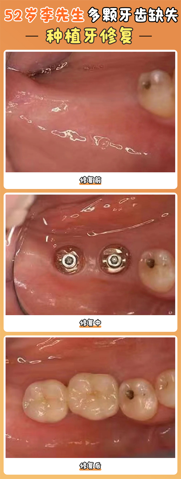 焦作植得口腔種植牙1980元質(zhì)量怎么樣