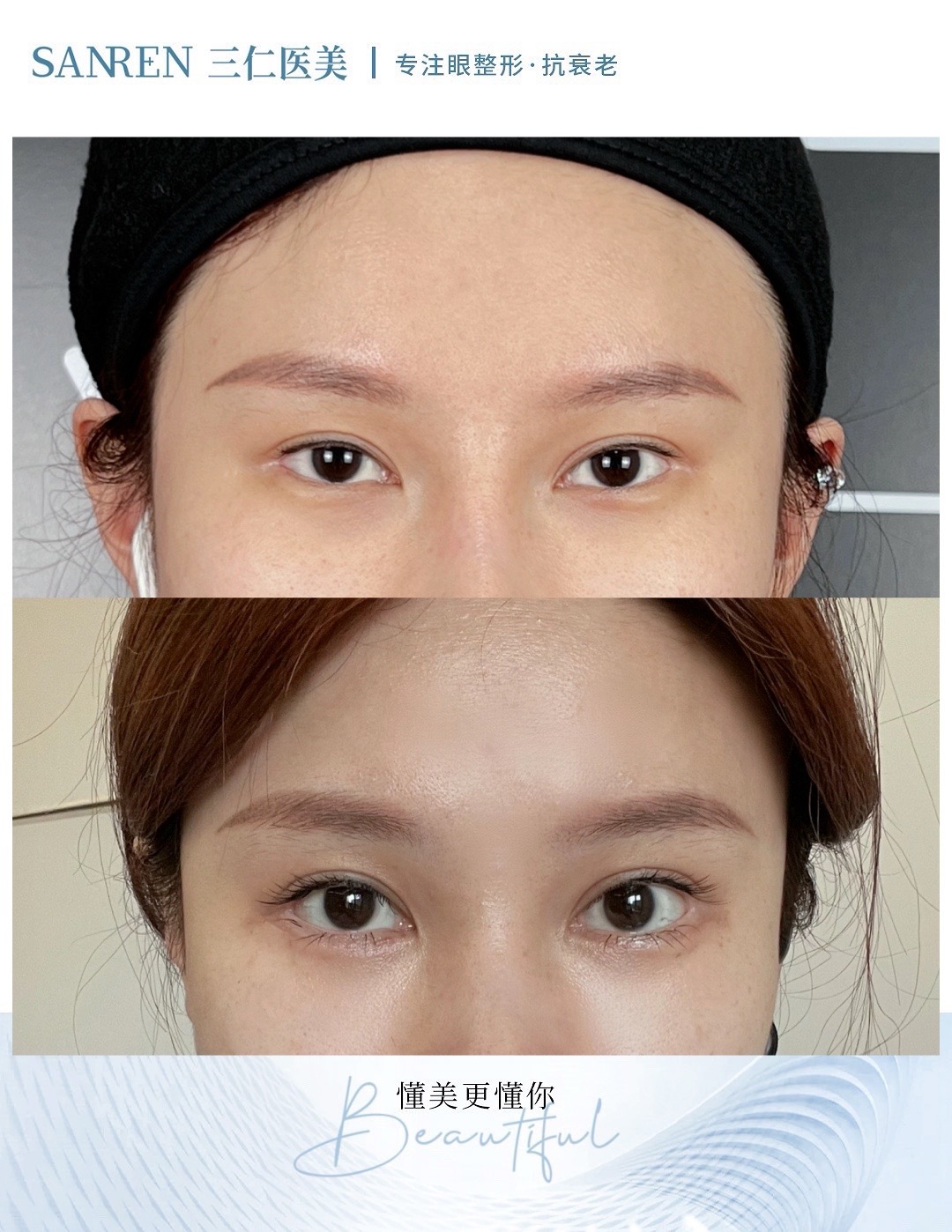 上海九院雙眼皮修復(fù)預(yù)約攻略：如何快速掛到骨干醫(yī)生號(hào)