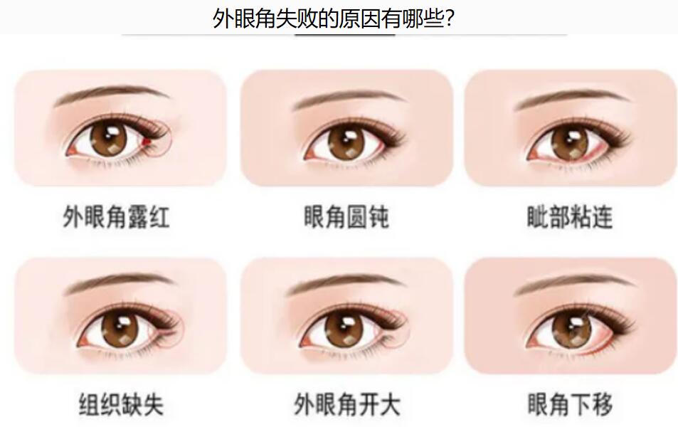 王世勇修復(fù)雙眼皮能無(wú)痕嗎？王世勇小切口/減張技術(shù)讓眼修復(fù)疤痕幾乎看不見(jiàn)，附價(jià)格