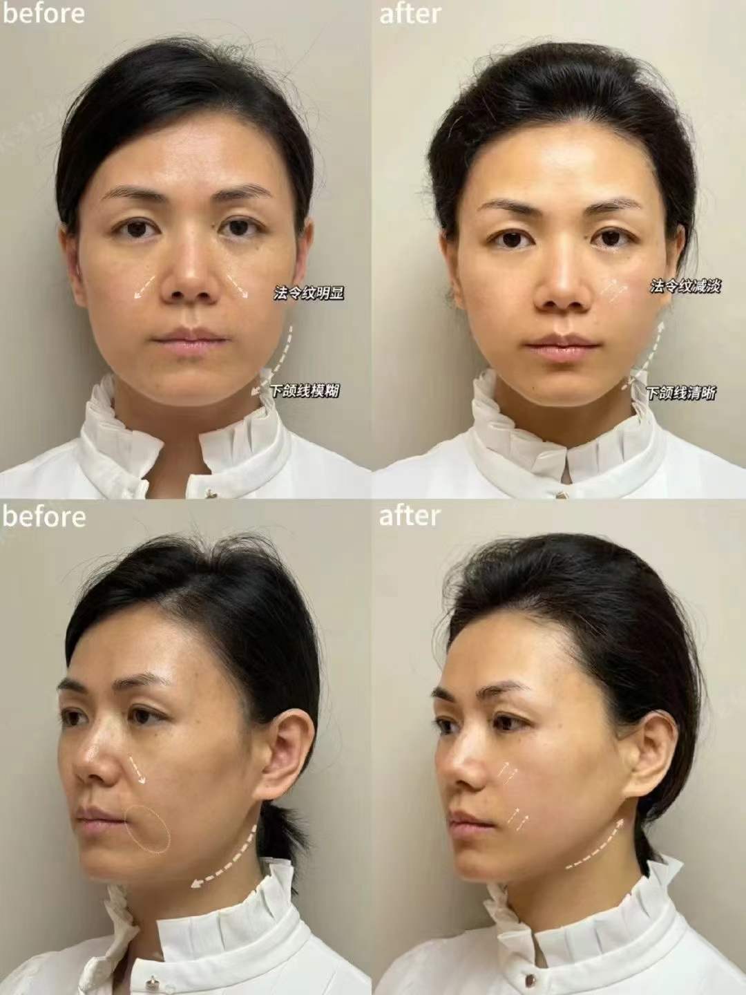 超聲王成效維持：不同醫(yī)院有何差異？