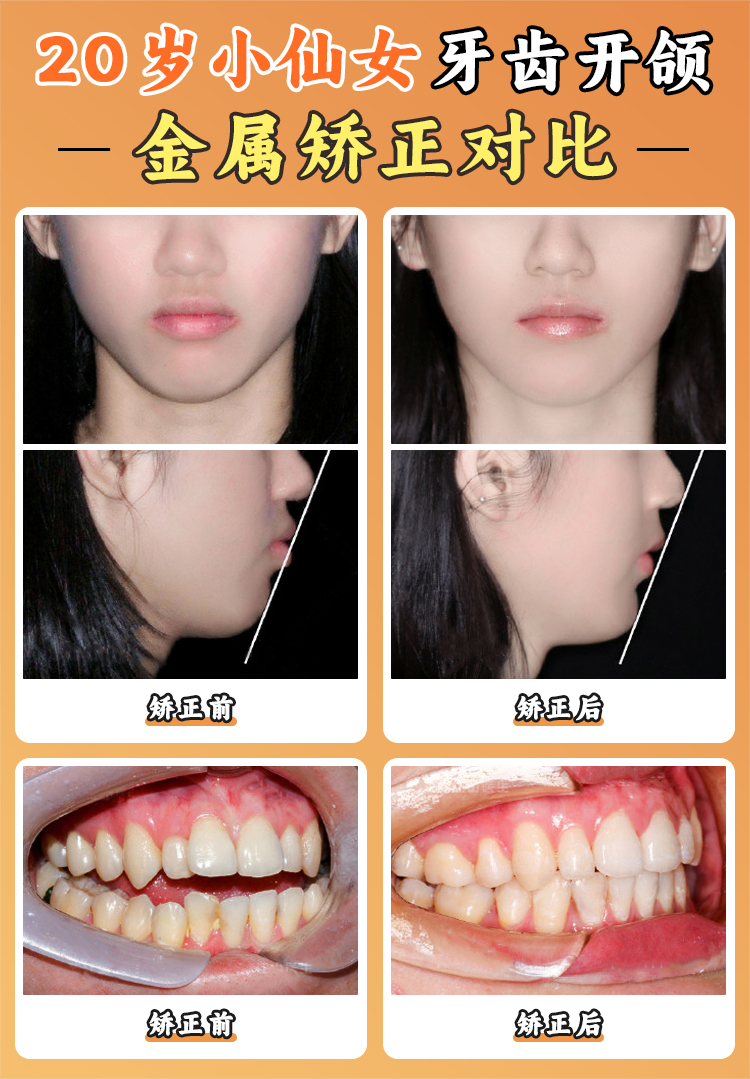 泰康拜博口腔2026價目表曝光！種植牙3980起、矯正9800起，費用透明可參考 