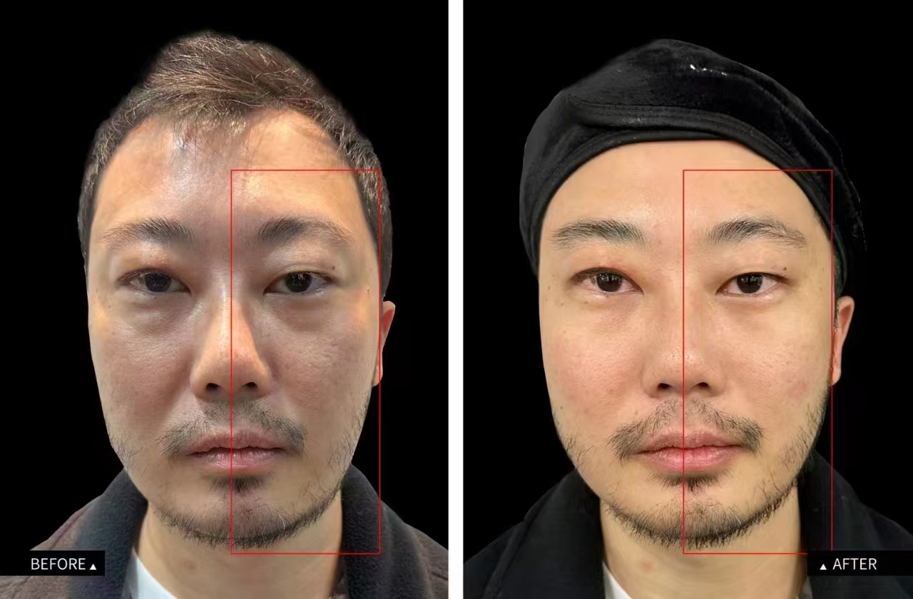 北京沃爾劉彥軍實力修復鼻整形失敗，10w起開啟精致美鼻重塑之旅 