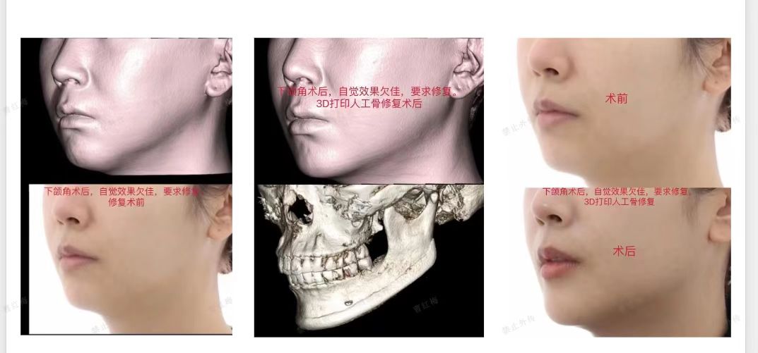 下颌角截骨手术