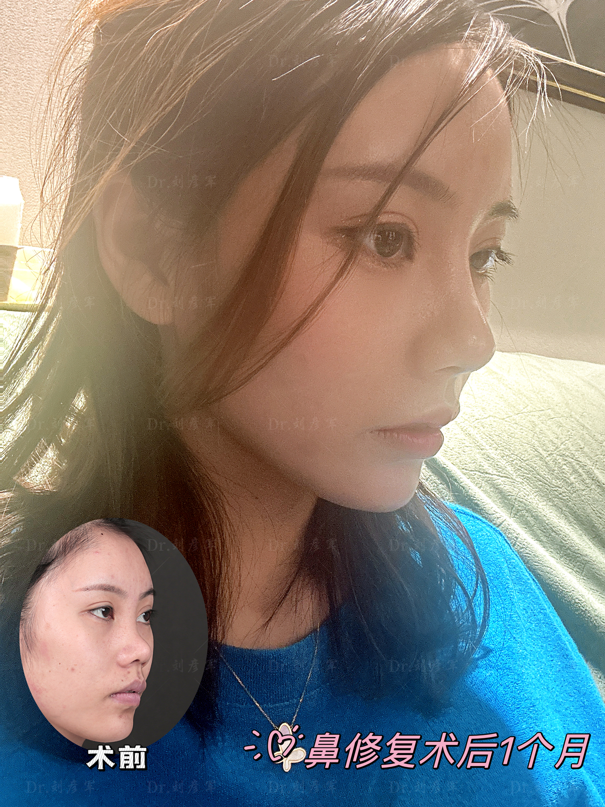 上海九院鼻子注射物取出多少钱？面部清奥6000起，价格明细全公开