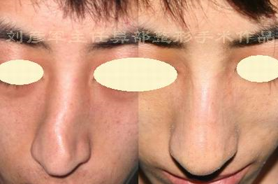 上海九院鼻子注射物取出用什么技术？可视化内镜清奥术超安心