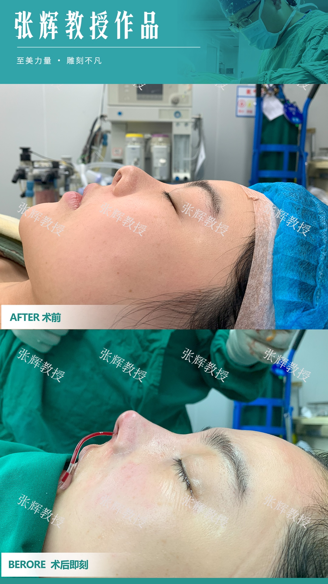 上海九院鼻子注射物取出真实实例：姐妹亲测，清奥成功不踩坑