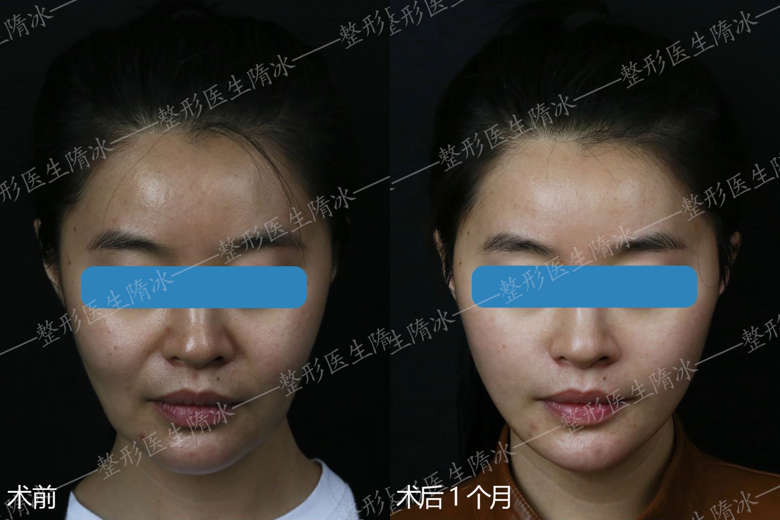 熱瑪吉全臉項目有什么優(yōu)勢？