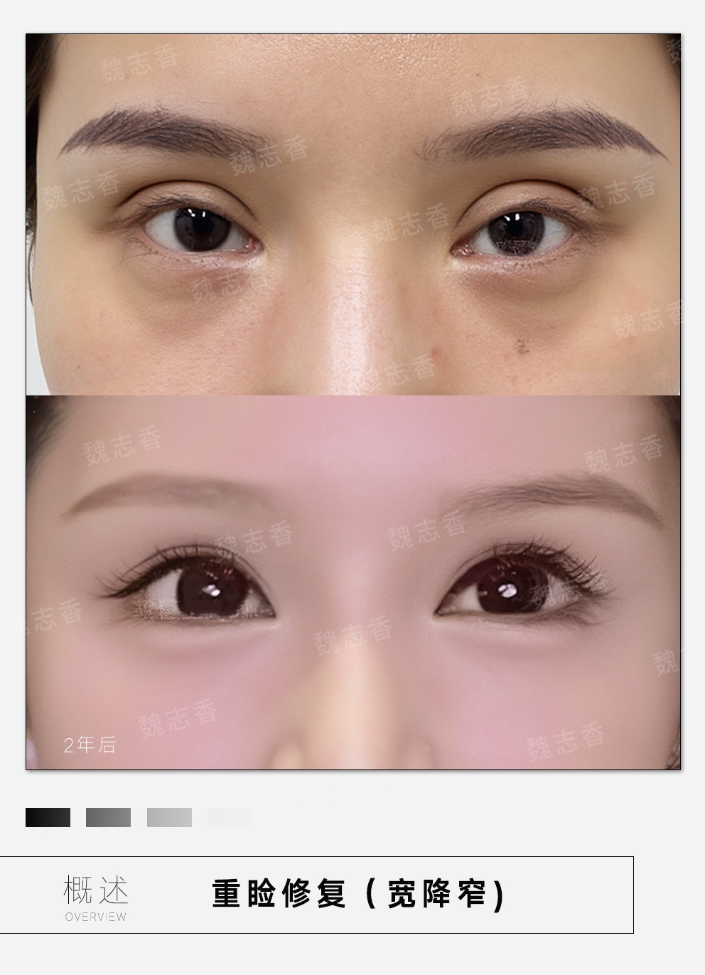 選擇北京嘉禾蔡圣民熱瑪吉全臉項目需要注意什么？