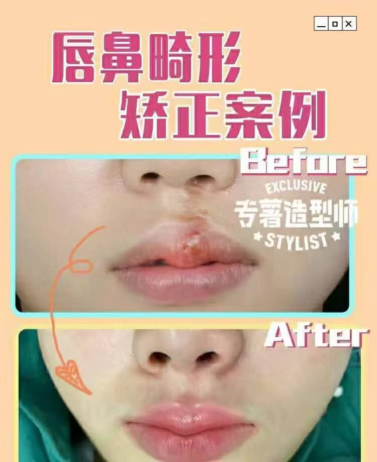 上海九院鼻骨復(fù)位哪個醫(yī)生好？實力骨干醫(yī)生團隊揭秘