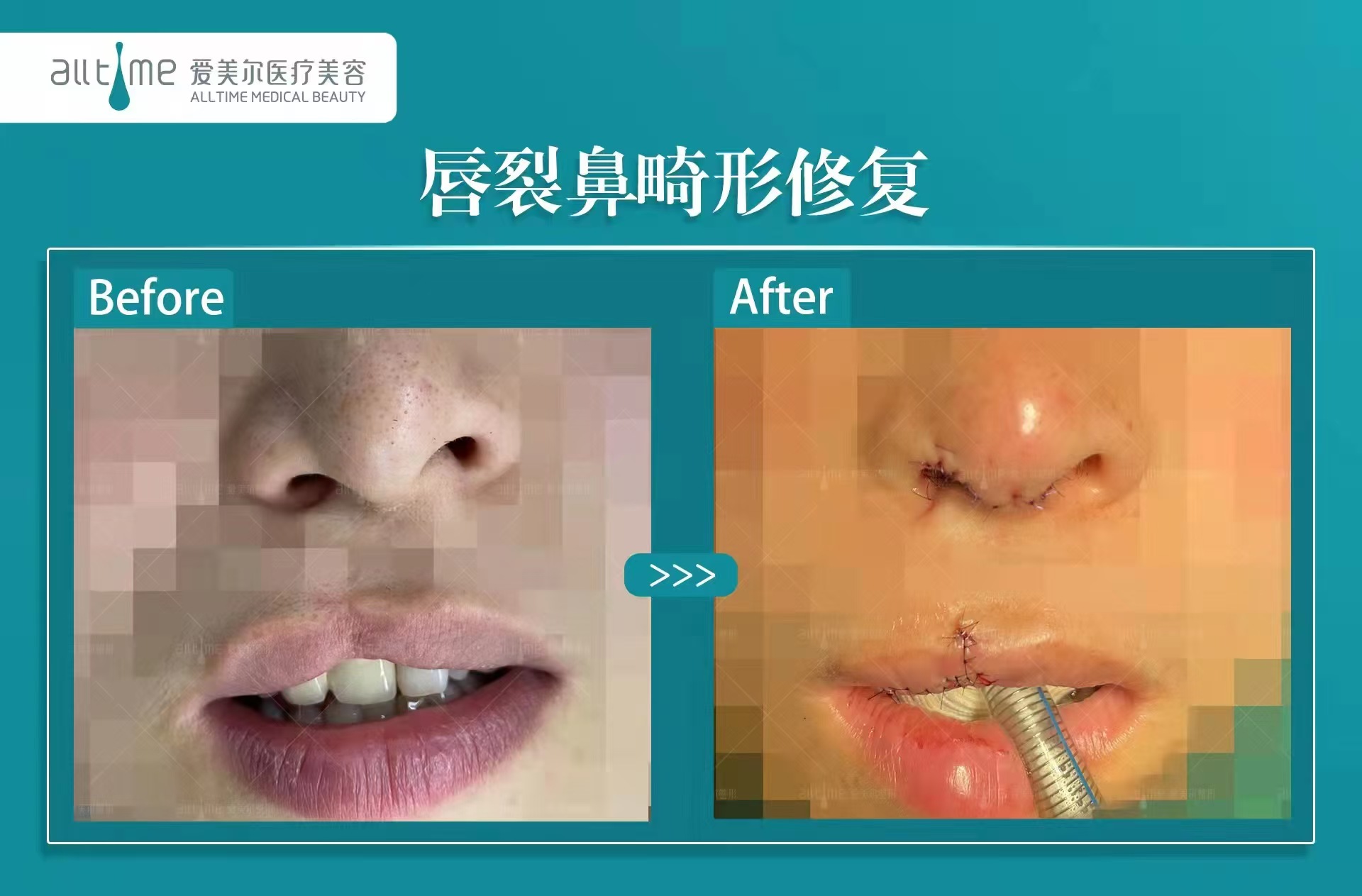 上海九院鼻骨骨折復(fù)位技術(shù)：精細復(fù)位不盲目