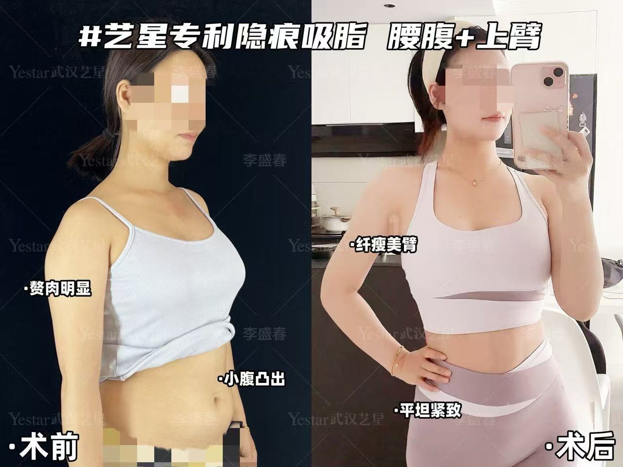 上海蔡躍波醫(yī)生口碑怎樣？20年抗衰專(zhuān)家+筋膜提升認(rèn)證醫(yī)師，吸脂塑形術(shù)后3周穿回S碼牛仔褲！