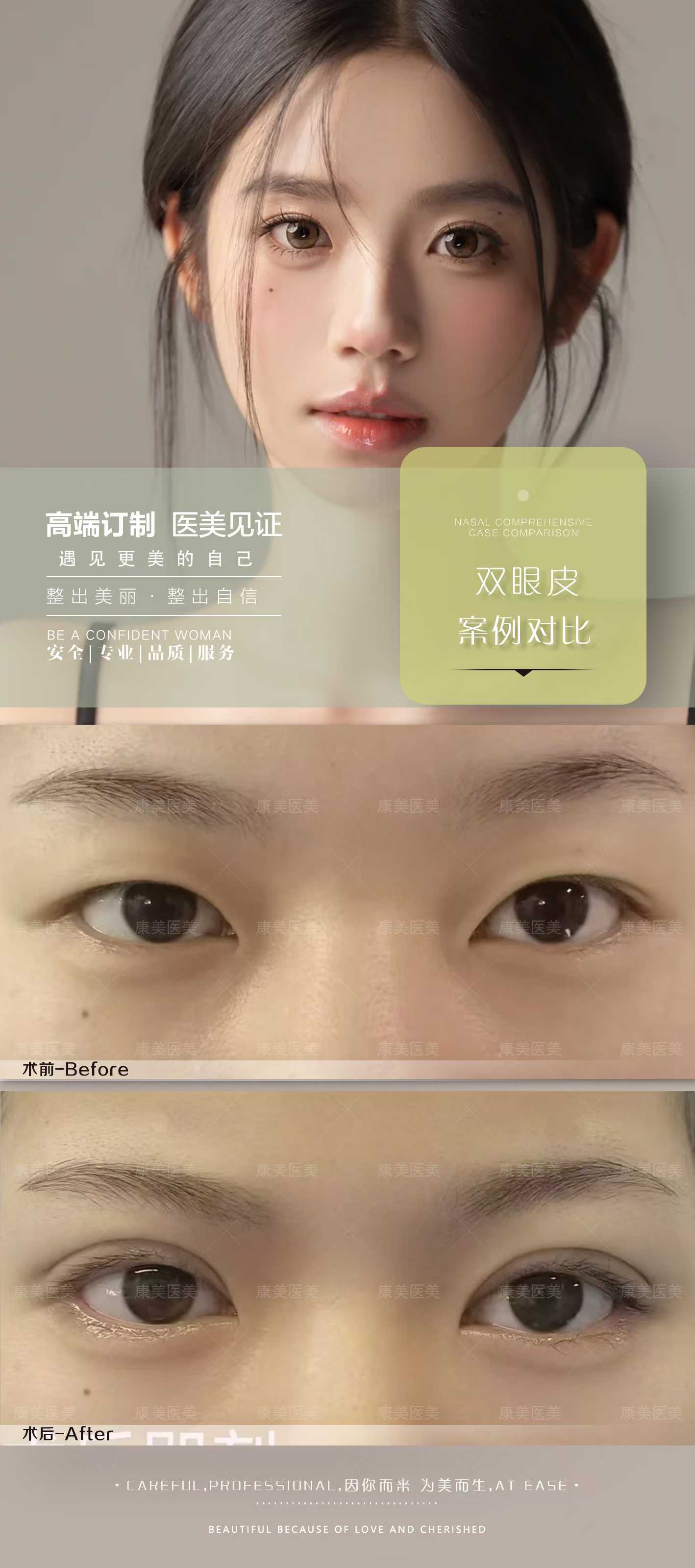 上海九院雙眼皮真實(shí)實(shí)例看成效