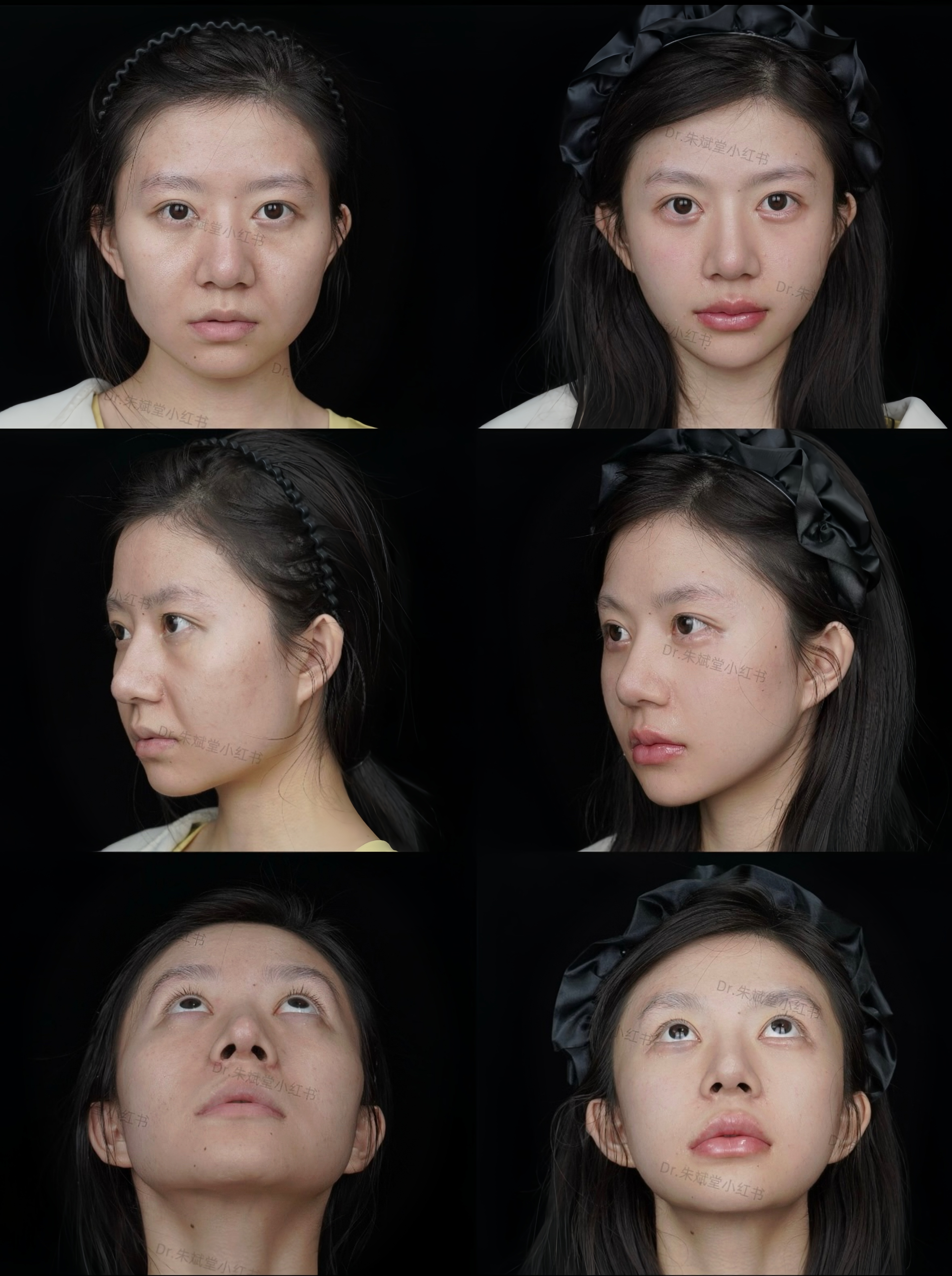 張沙沙畫美醫(yī)生做眼袋怎么樣？?jī)?nèi)切1893元起，眶隔釋放改善淚溝