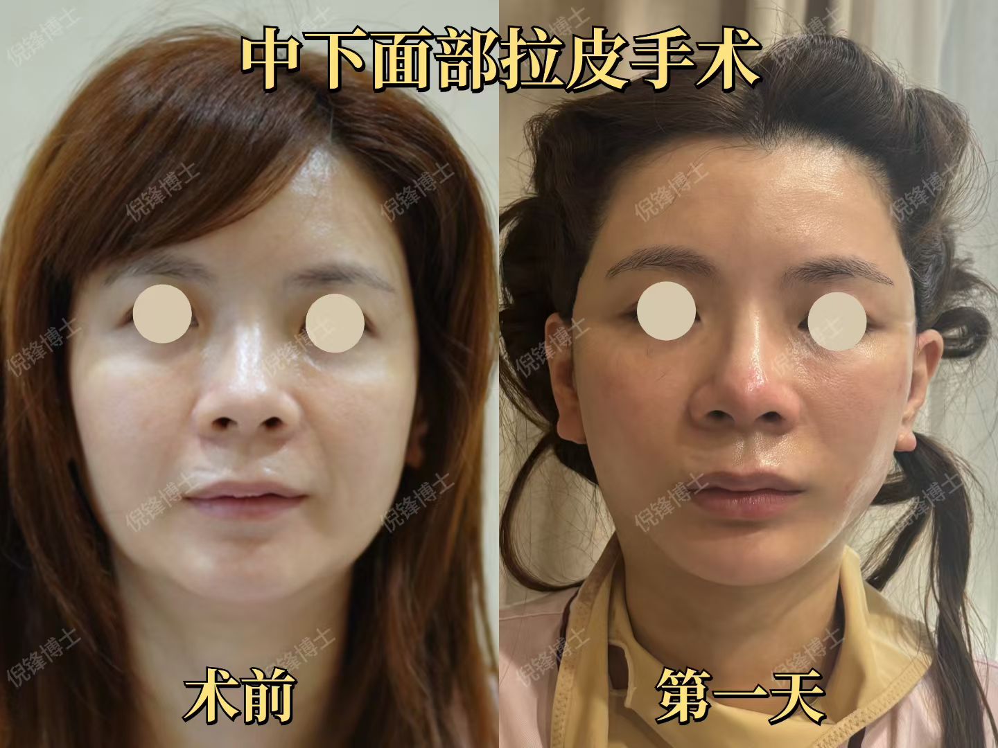 2. 上海九院拉皮整形醫(yī)生張余光：小切口骨干醫(yī)生，拒絕“假面感”