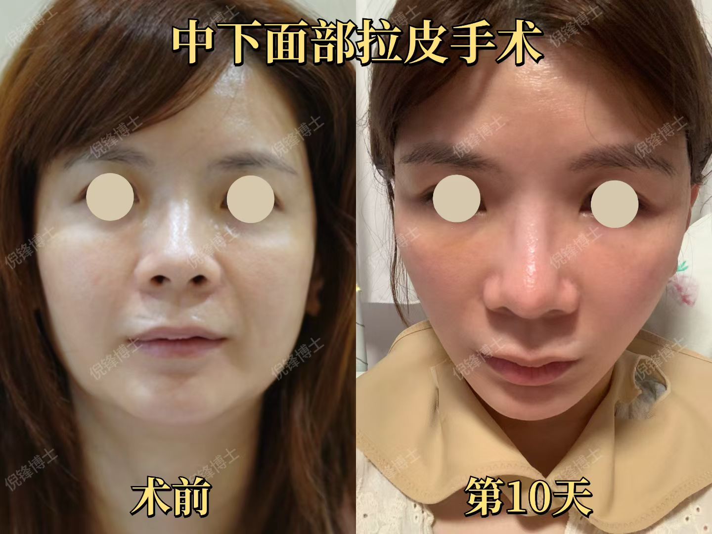 3. 上海九院拉皮醫(yī)生丁偉：經(jīng)瞼緣小切口，拉皮+去眼袋一舉兩得