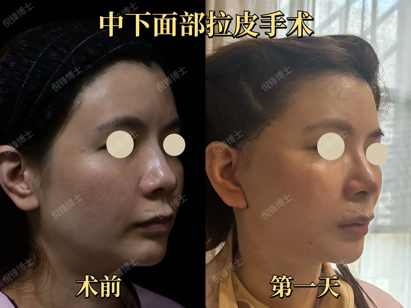 5. 上海九院拉皮醫(yī)生劉菲：微創(chuàng)+非侵入，術(shù)后維持久反彈低