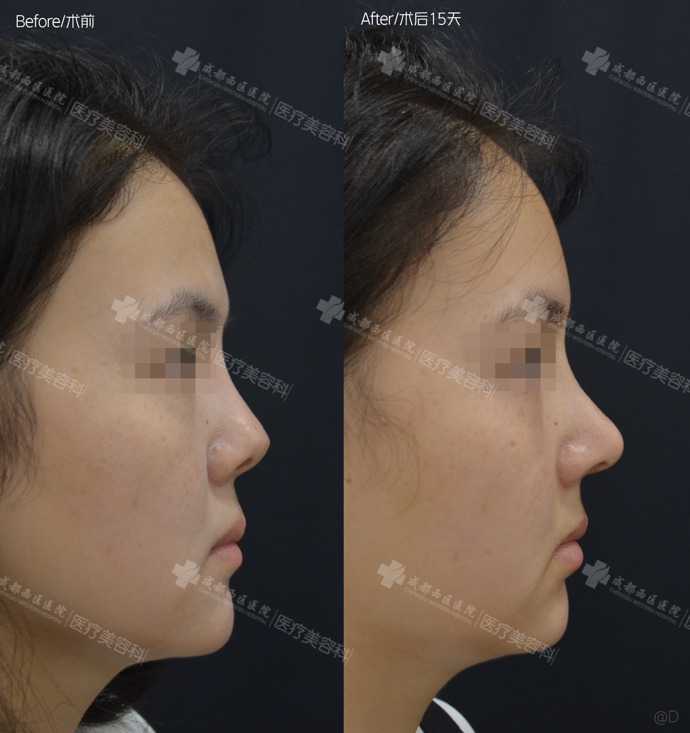 四川奧美定取出排名前三醫(yī)院——整形外科醫(yī)院