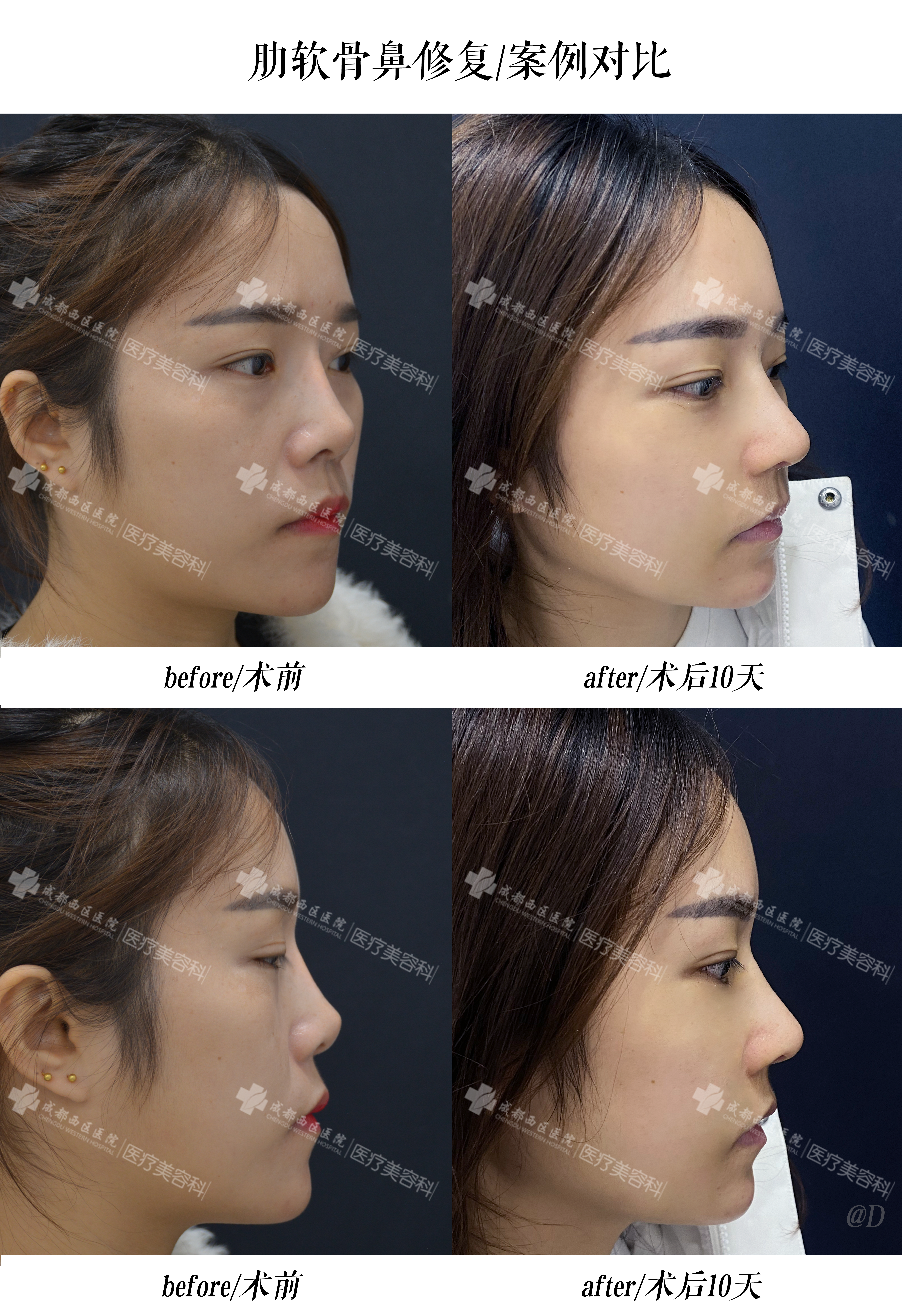 四川奧美定取出排名前三醫(yī)院——紫馨整形醫(yī)院