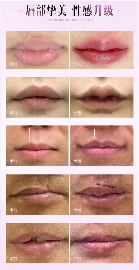 北京人中縮短術(shù)的避坑指南