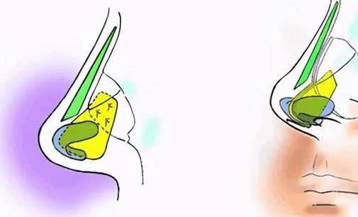 廣州何純修復(fù)鼻子咋樣？上千例實例+患者真實反饋，都是真心話