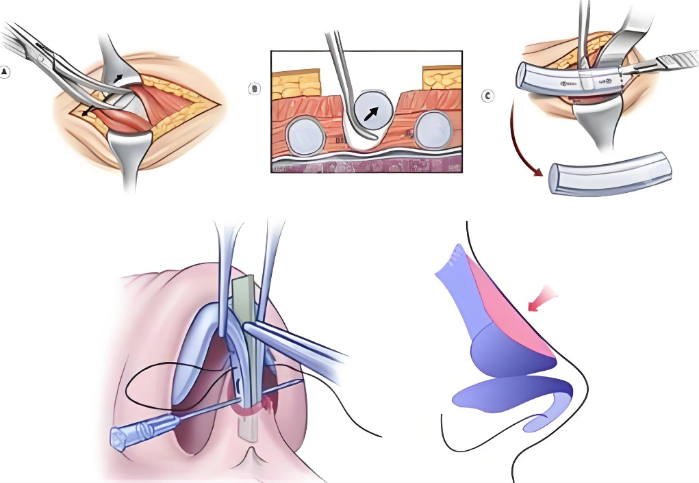 廣州何純修復(fù)鼻子術(shù)后注意事項