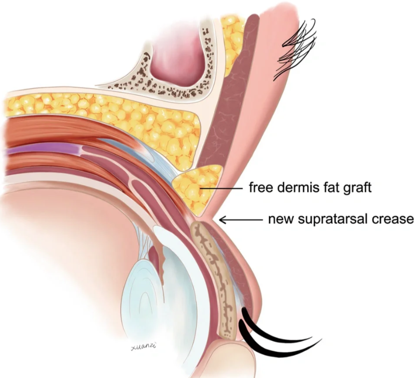 如何精細(xì)匹配適合你的雙眼皮骨干醫(yī)生